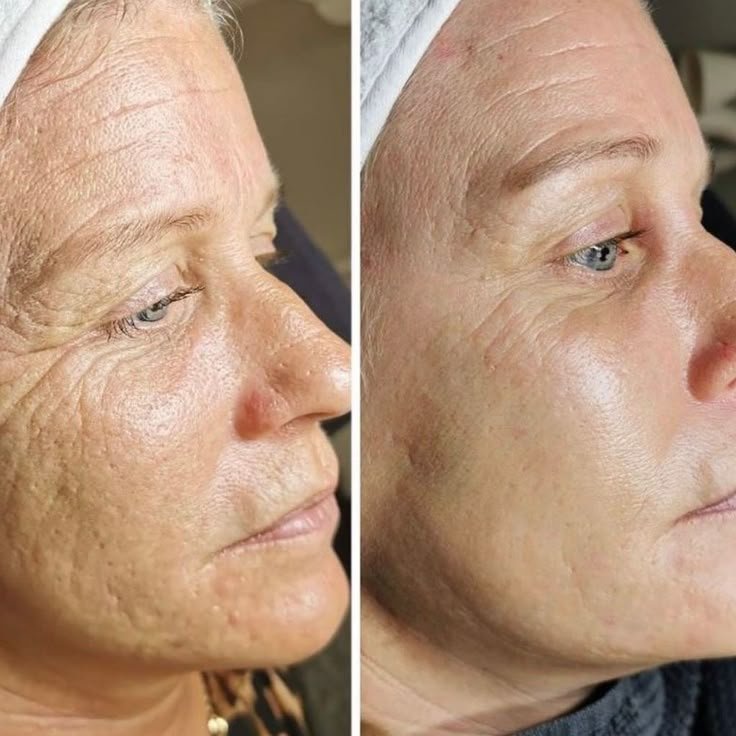 At Home or Professional Microneedling – Which Is Better_